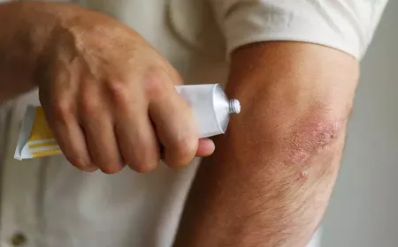 Top 7 Best Antifungal Creams in the Philippines